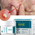 Acne Cream for Clear Skin | Pimples Removal & Scar Repair Formula